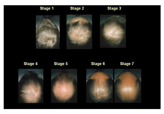 男性型脱毛症（AGA）の薄毛のステージ・進行度